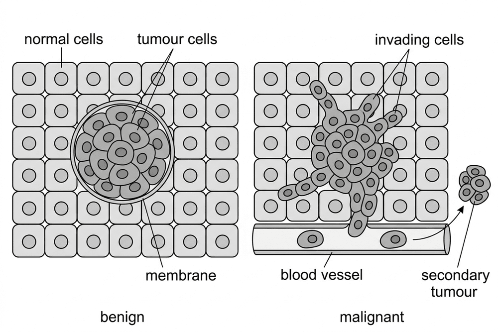 bio benign malignant tumour